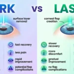 PRK vs LASIK